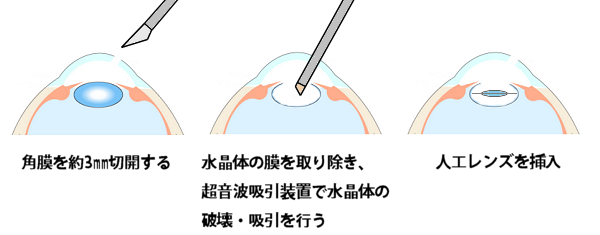 犬の白内障の手術